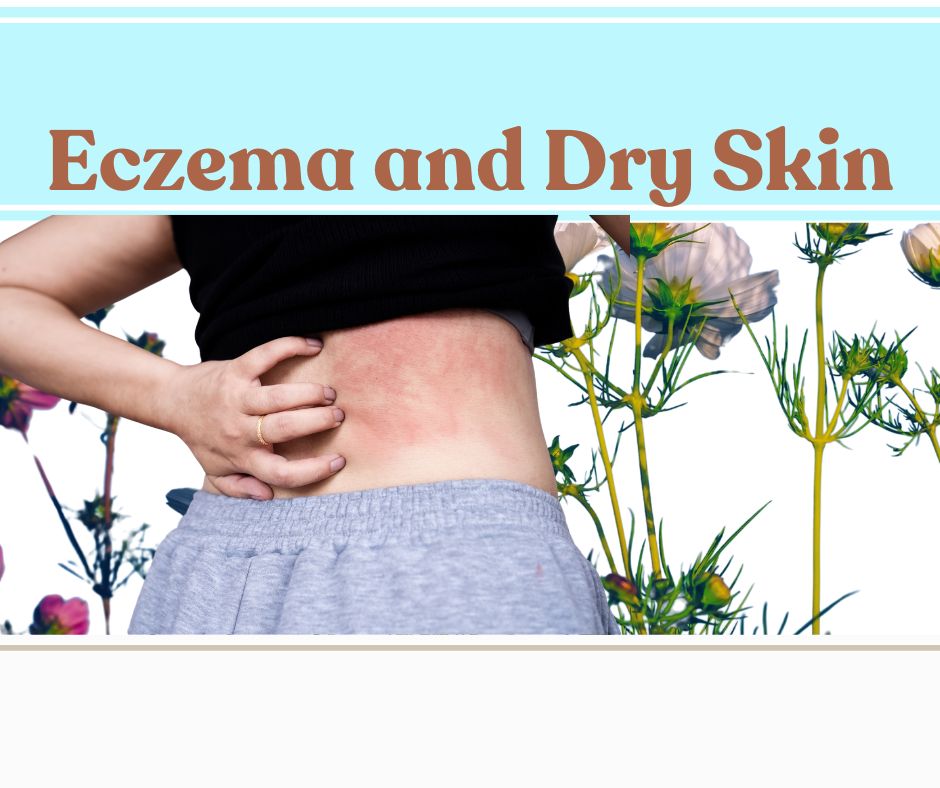 Eczema and Dry Skin: Embrace the power of nature for softer, healthier skin!