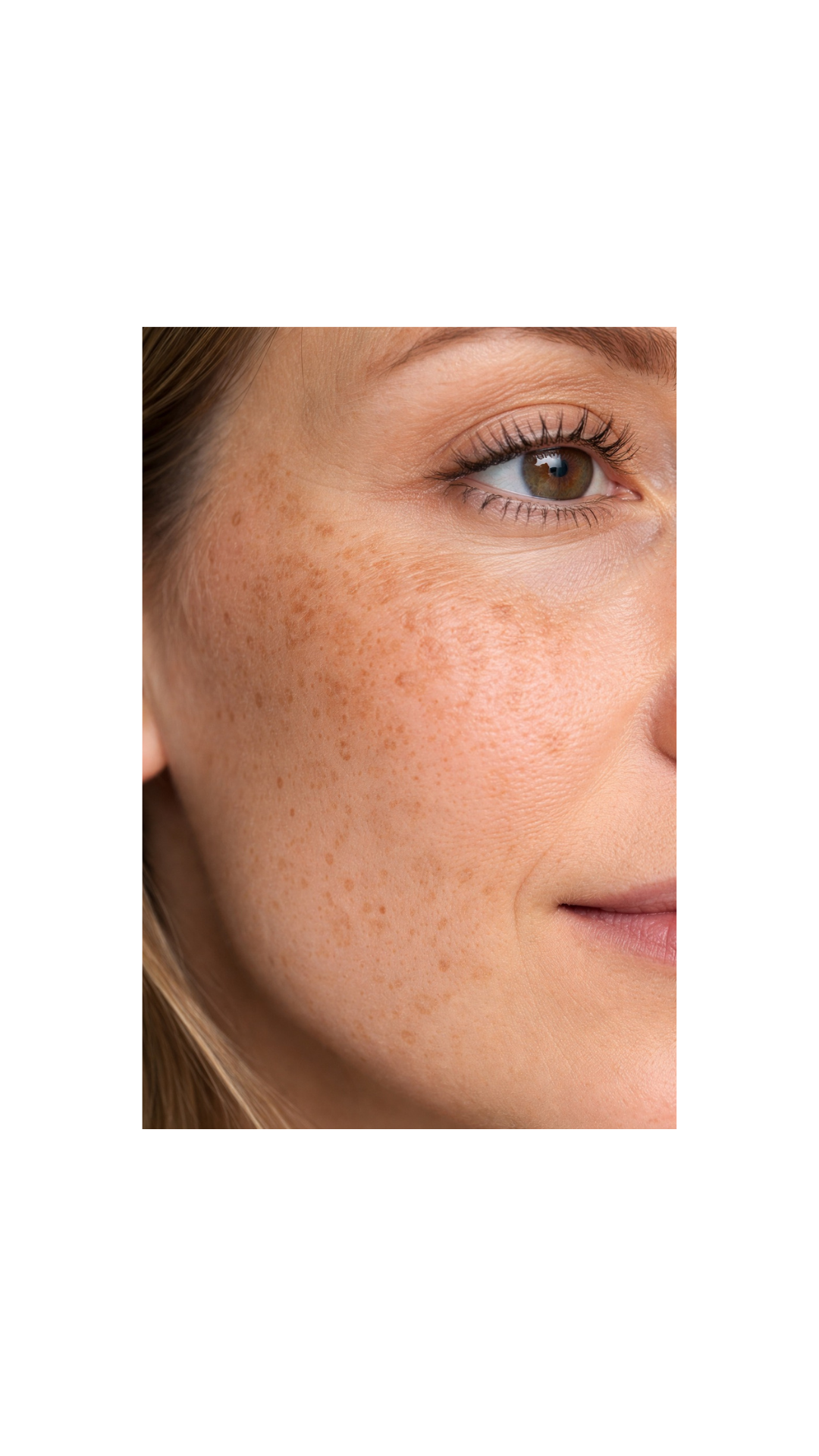Pigmentation Often Begins Before You Even See It!